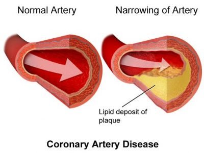CoronaryArteryDisease